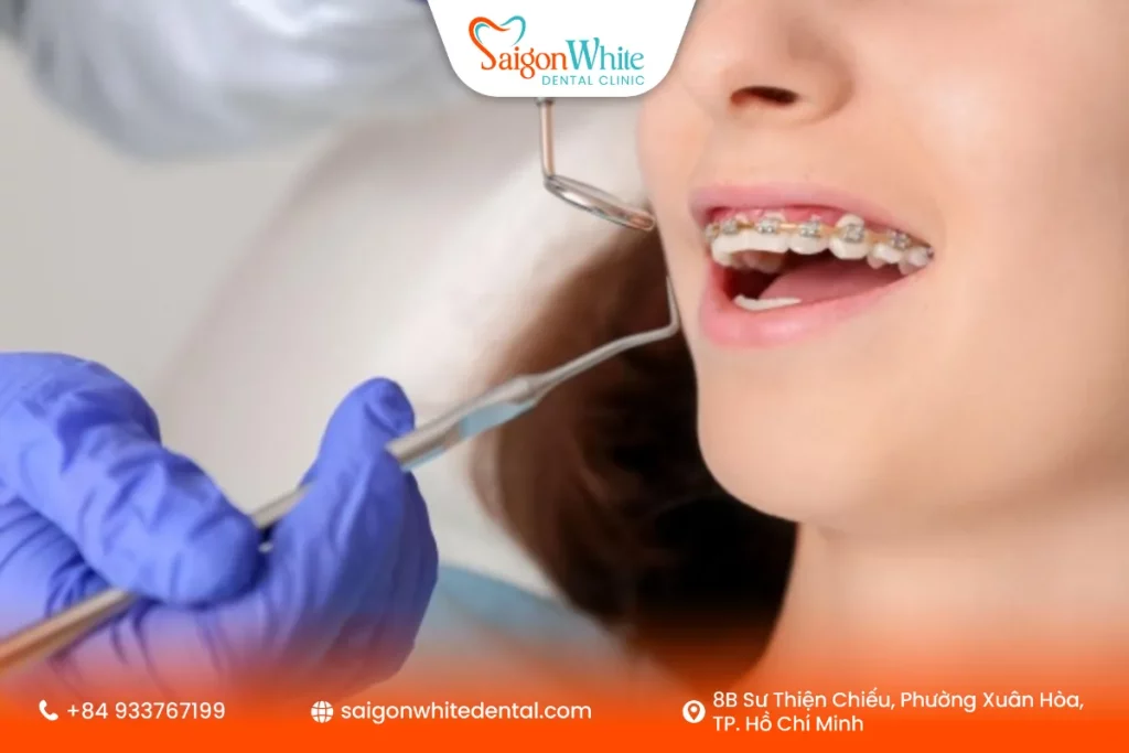 Niềng răng 1 hàm là gì?