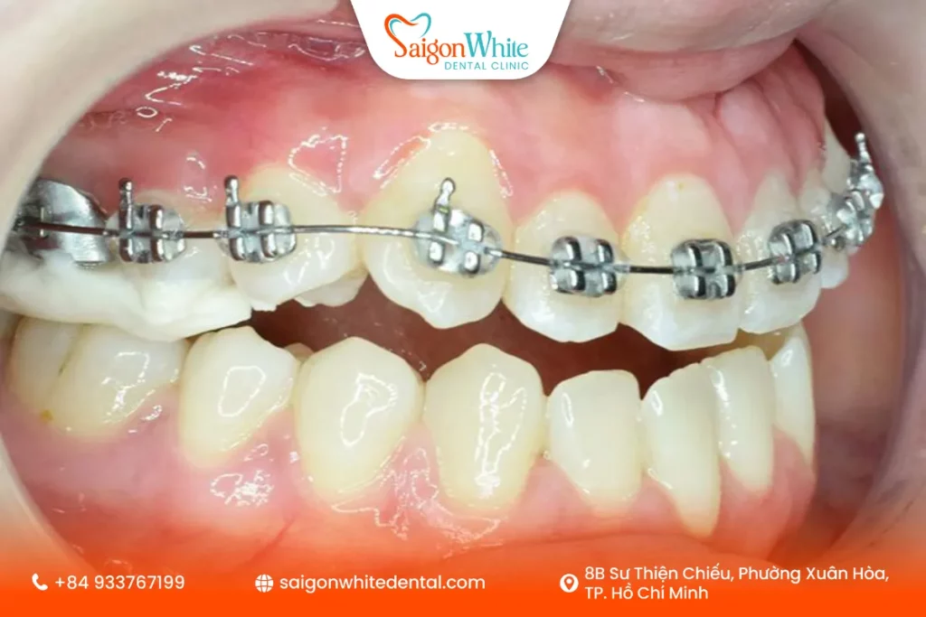 Niềng răng 1 hàm mất bao lâu?