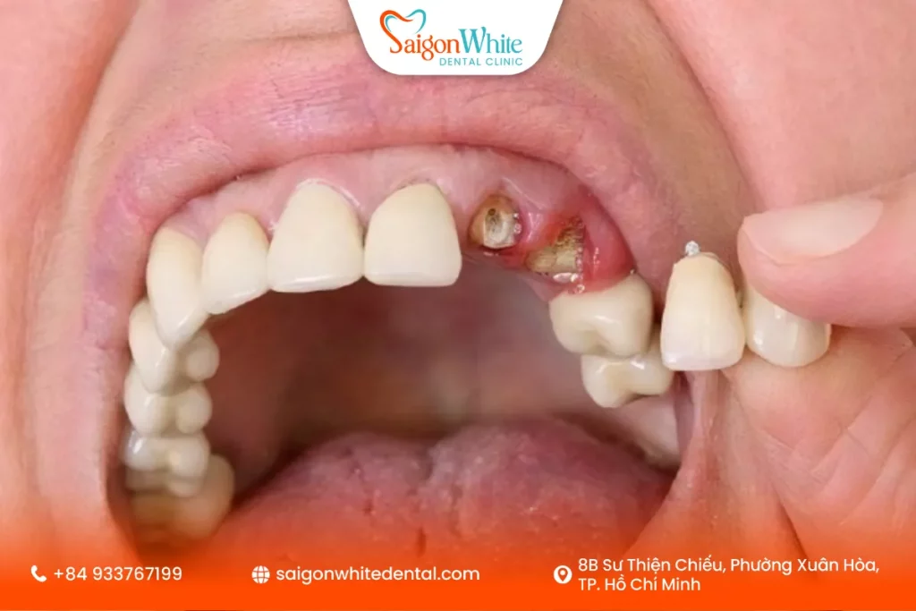 Răng bị gãy còn chân răng là gì?