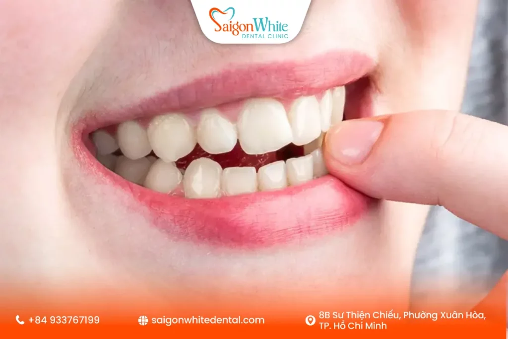 Răng bị lung lay có chắc lại như ban đầu không?