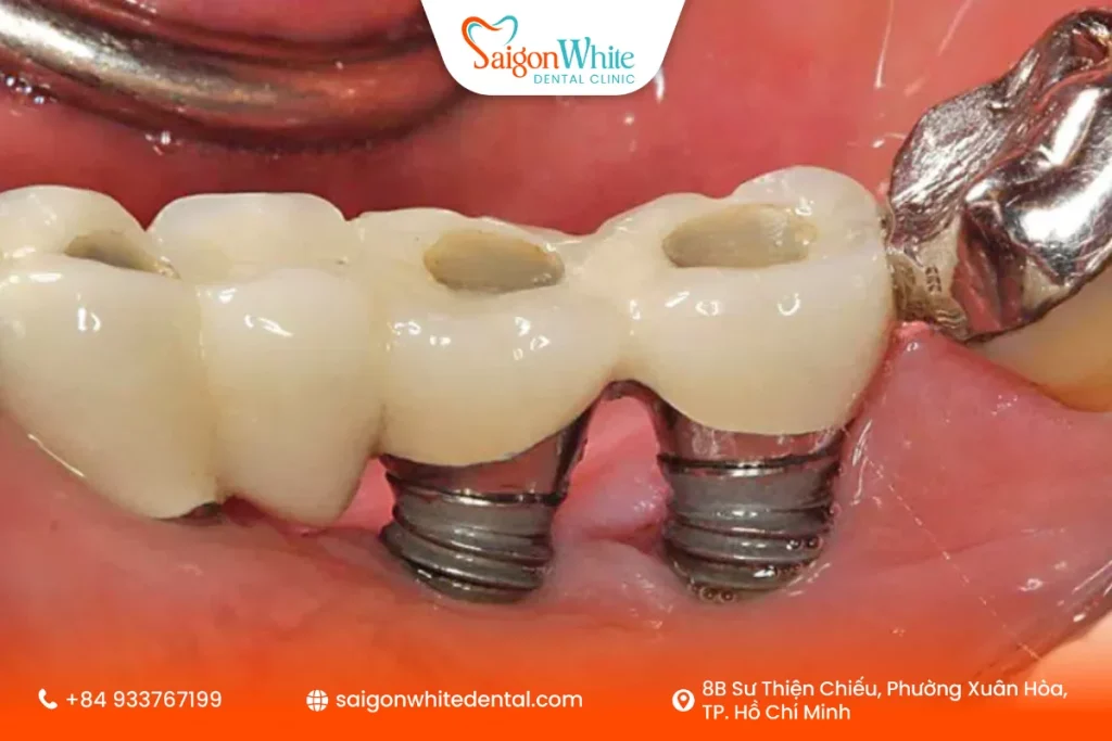 Trụ implant không rõ nguồn gốc đang bị đào thải