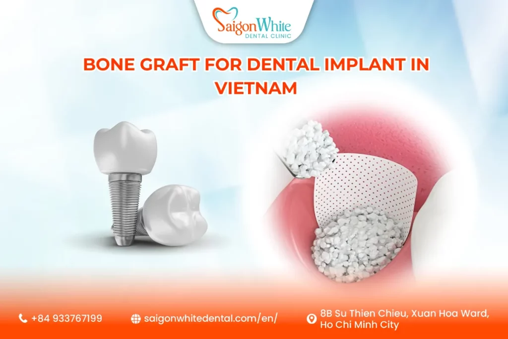 Bone Graft for Dental Implant in Vietnam