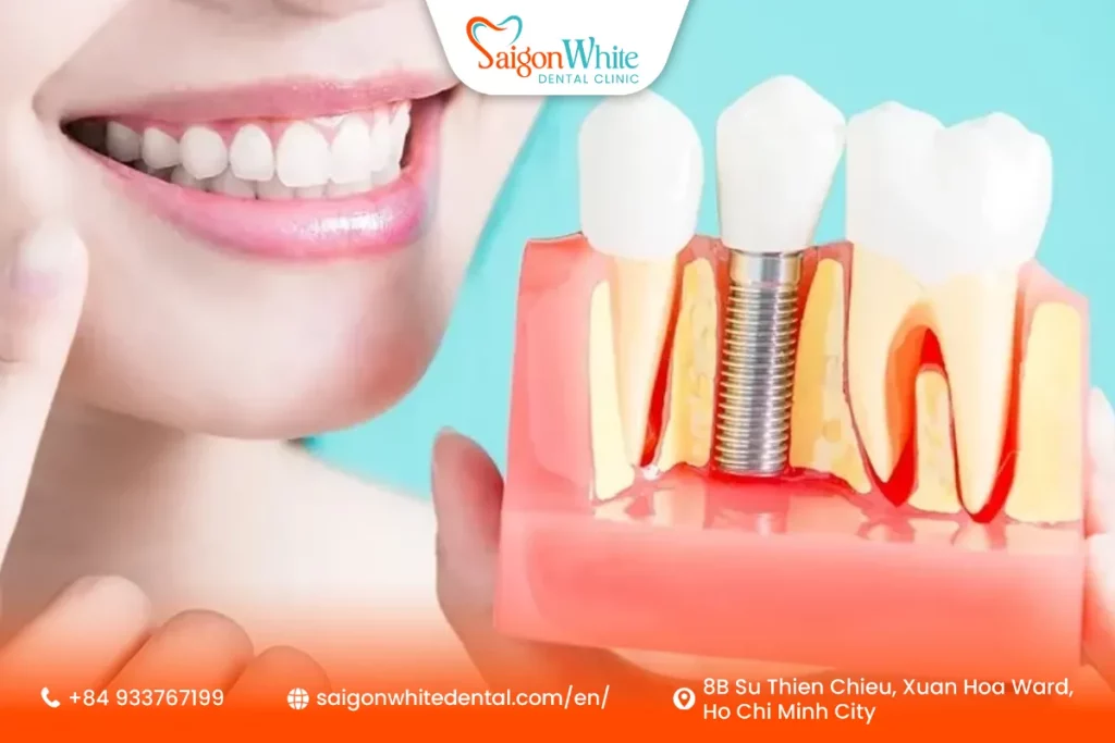 Why Do Some Patients Need a Bone Graft Before Dental Implants?