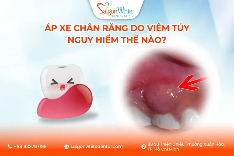 Áp xe chân răng do viêm tủy nguy hiểm thế nào?
