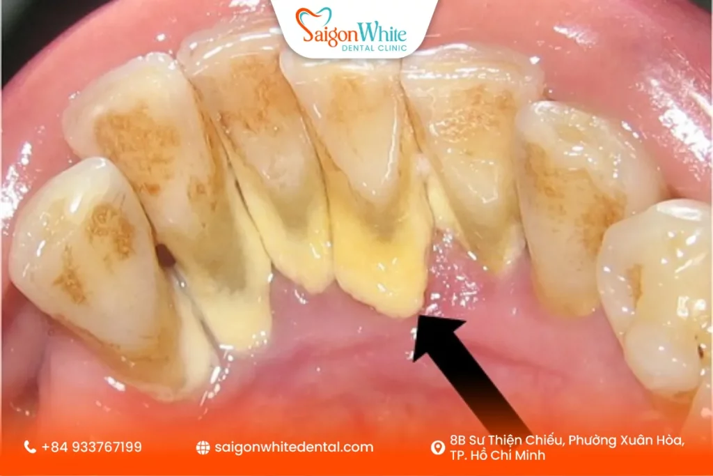 Bao lâu nên lấy cao răng một lần?