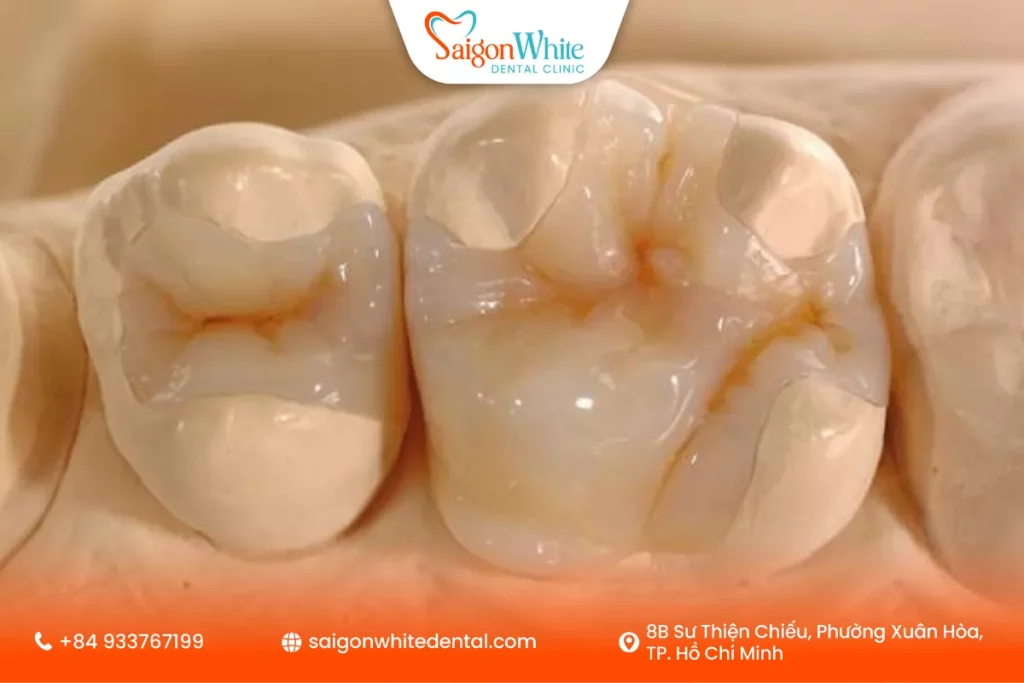 Bọc răng sứ inlay/onlay là gì?