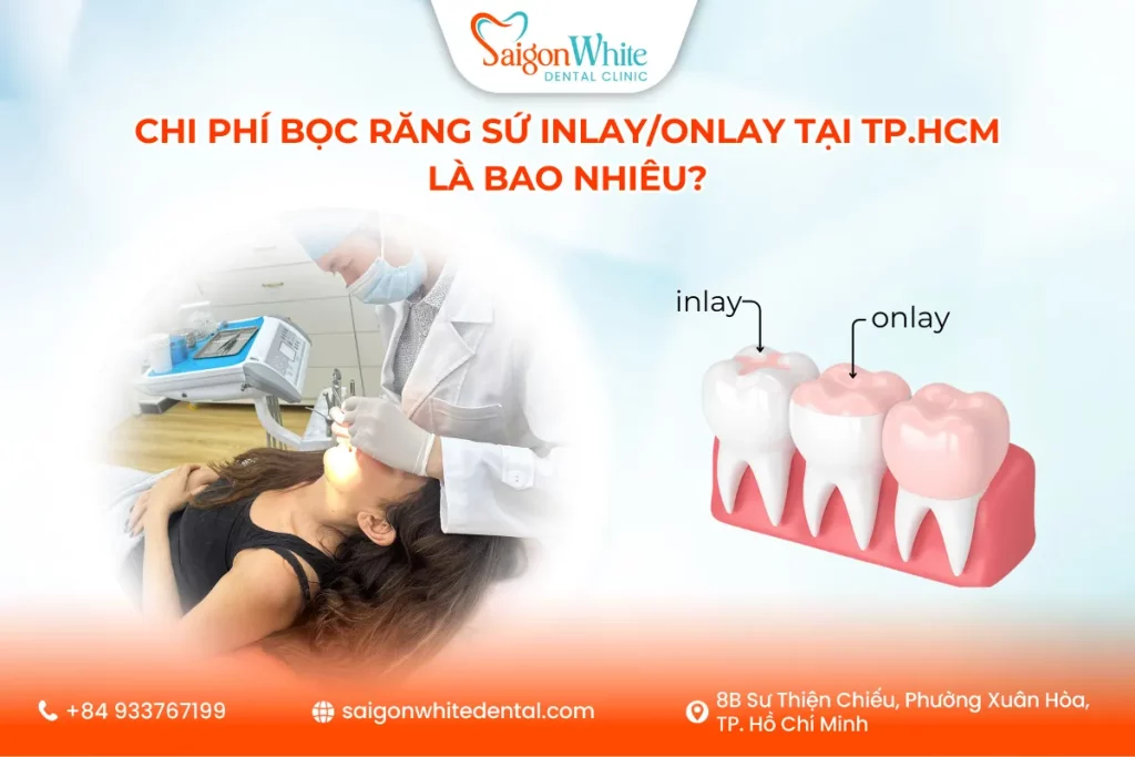 Chi Phí Bọc Răng Sứ Inlay/Onlay Tại Tp.HCM Là Bao Nhiêu?