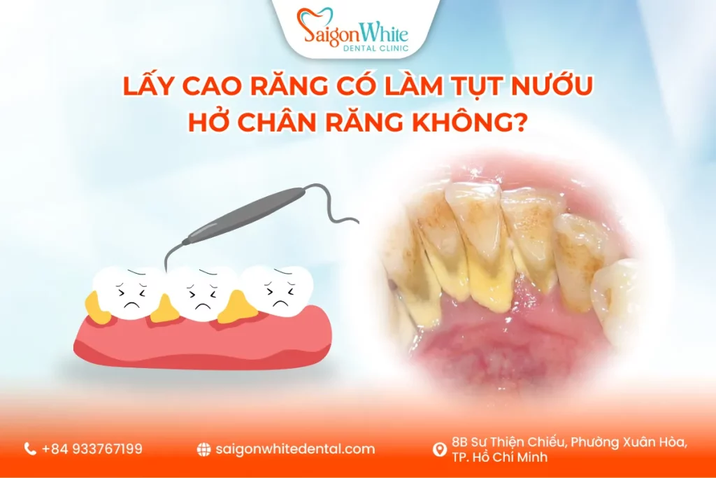 Lấy Cao Răng Có Làm Tụt Nướu, Hở Chân Răng Không?