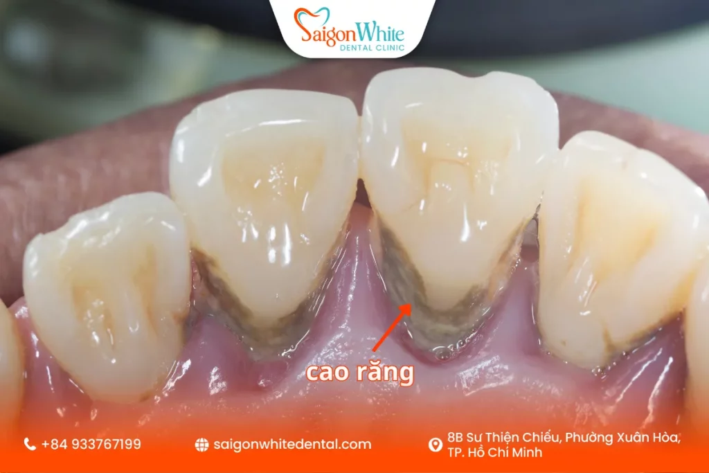 Lấy cao răng là gì?