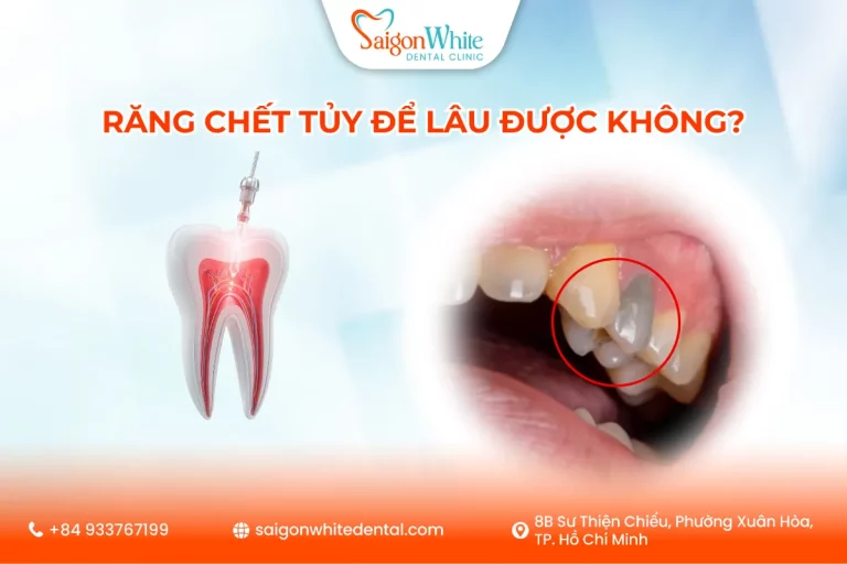 Răng Chết Tủy Để Lâu Được Không?