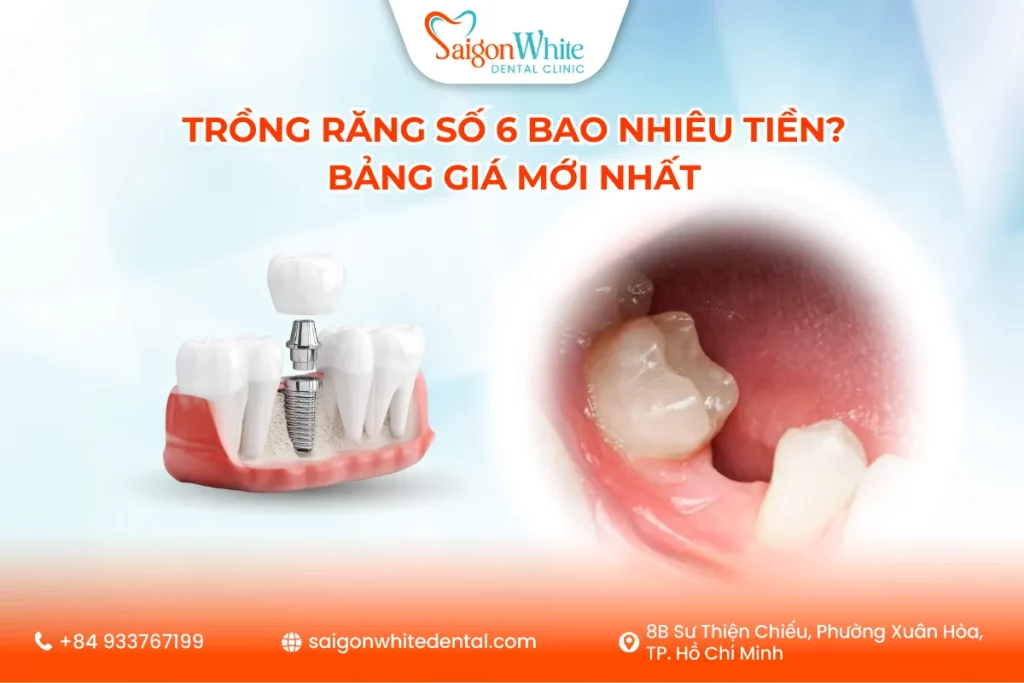 Trồng răng số 6 bao nhiêu tiền? Bảng giá mới nhất