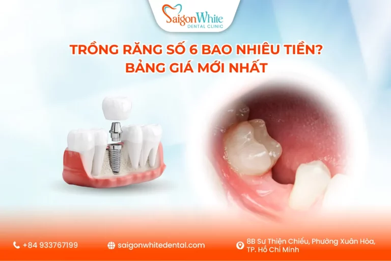 Trồng răng số 6 bao nhiêu tiền? Bảng giá mới nhất