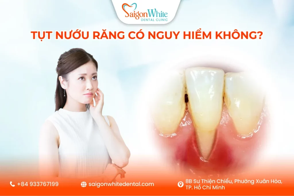 Tụt Nướu Răng Có Nguy Hiểm Không?