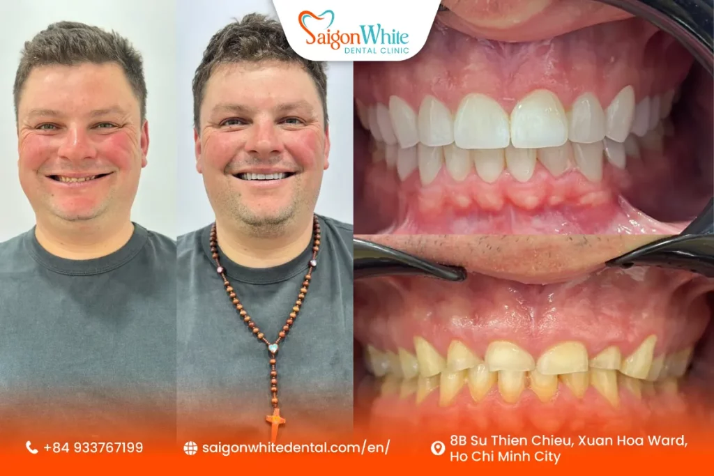 A client from Australia chose porcelain veneers at Saigon White Dental