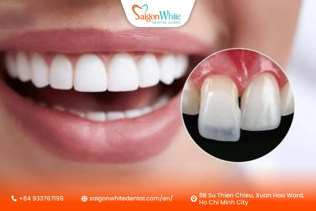 Dental Veneer