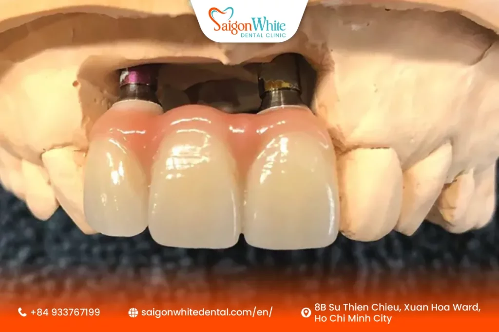 Implant-Supported Bridge