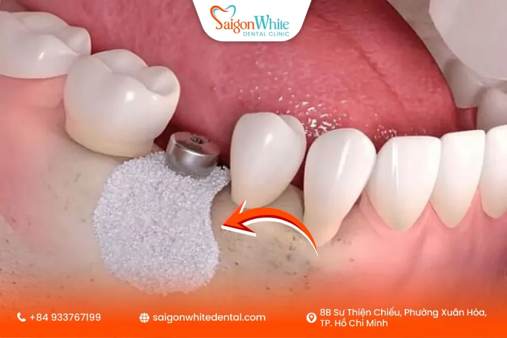 Ghép xương trong trồng Implant là gì?