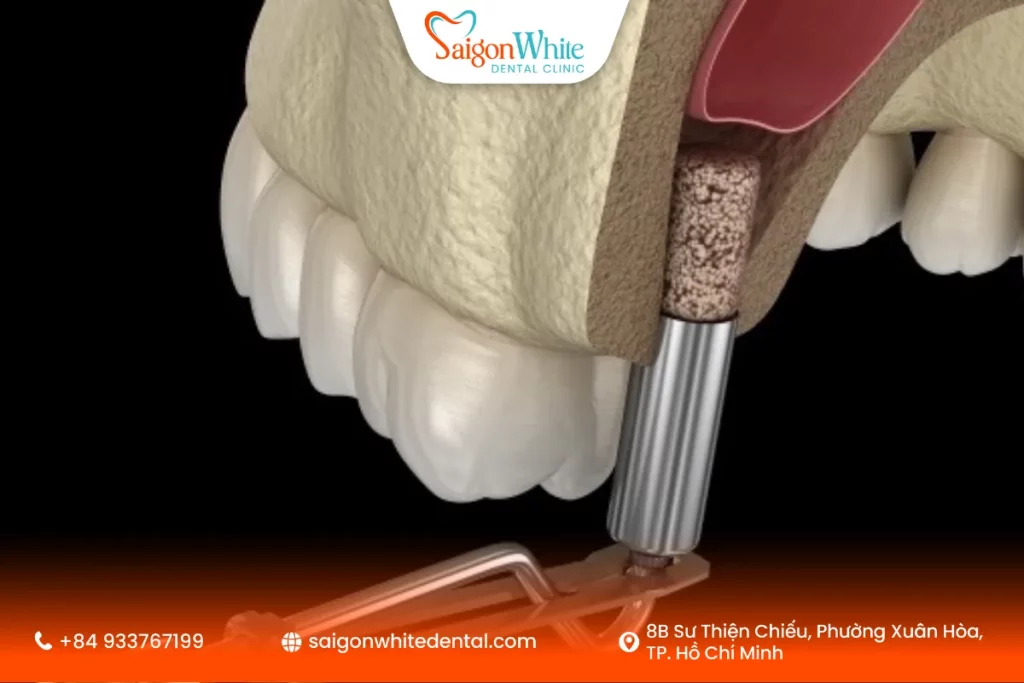 Nâng xoang hàm trong trồng Implant