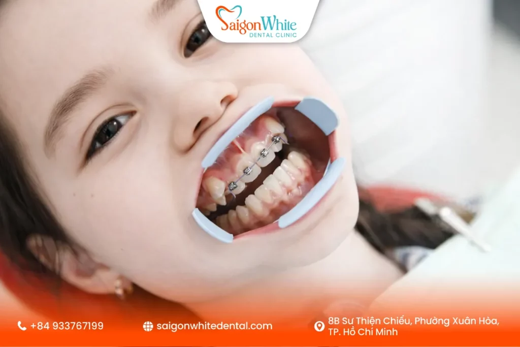 Quy trình nong hàm cho trẻ tại nha khoa