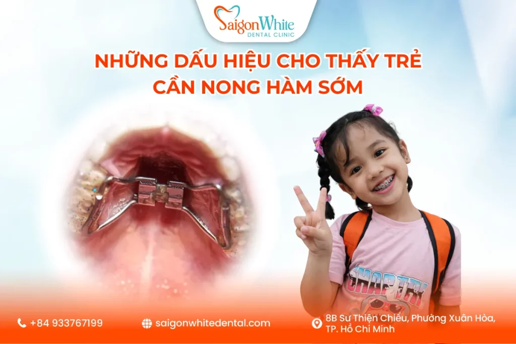 Những Dấu Hiệu Cho Thấy Trẻ Cần Nong Hàm Sớm