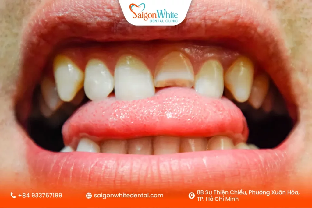 Răng bị gãy là gì? Các mức độ gãy răng thường gặp
