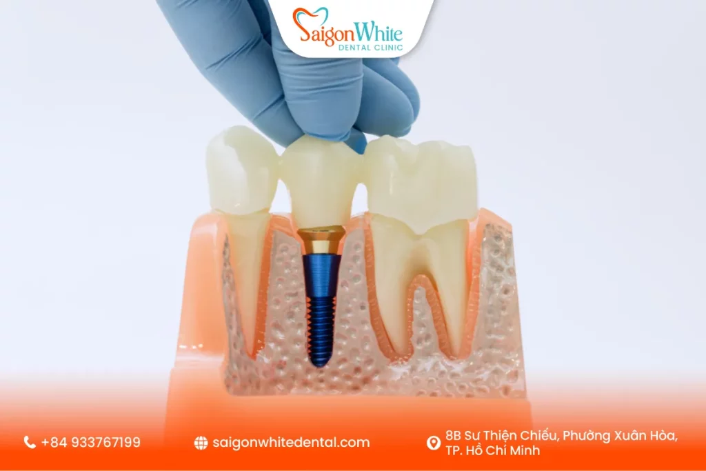 Trồng răng Implant hoặc làm cầu răng