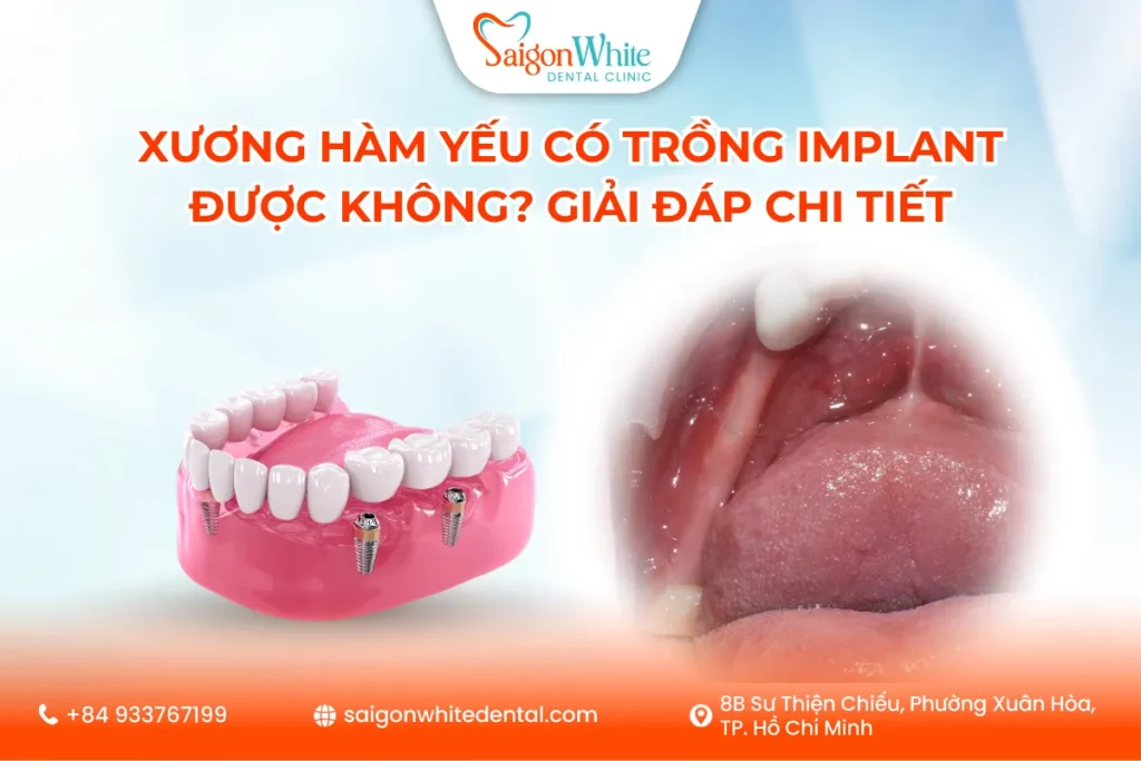 Xương hàm yếu có trồng Implant được không? Giải đáp chi tiết