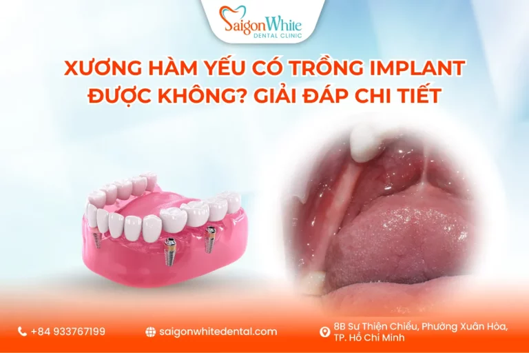 Xương hàm yếu có trồng Implant được không? Giải đáp chi tiết