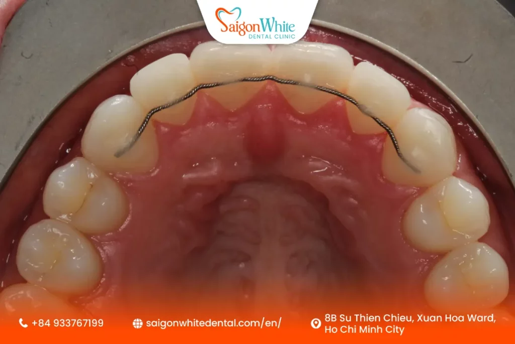 Bonded Retainer at Saigon White Dental
