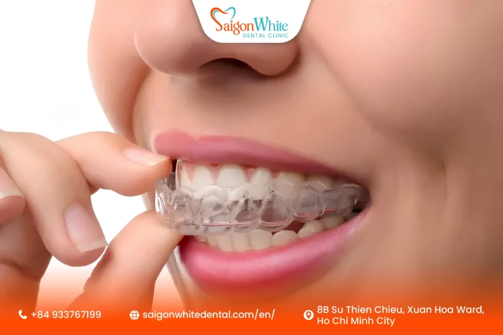 Clear Retainer Cost in Vietnam