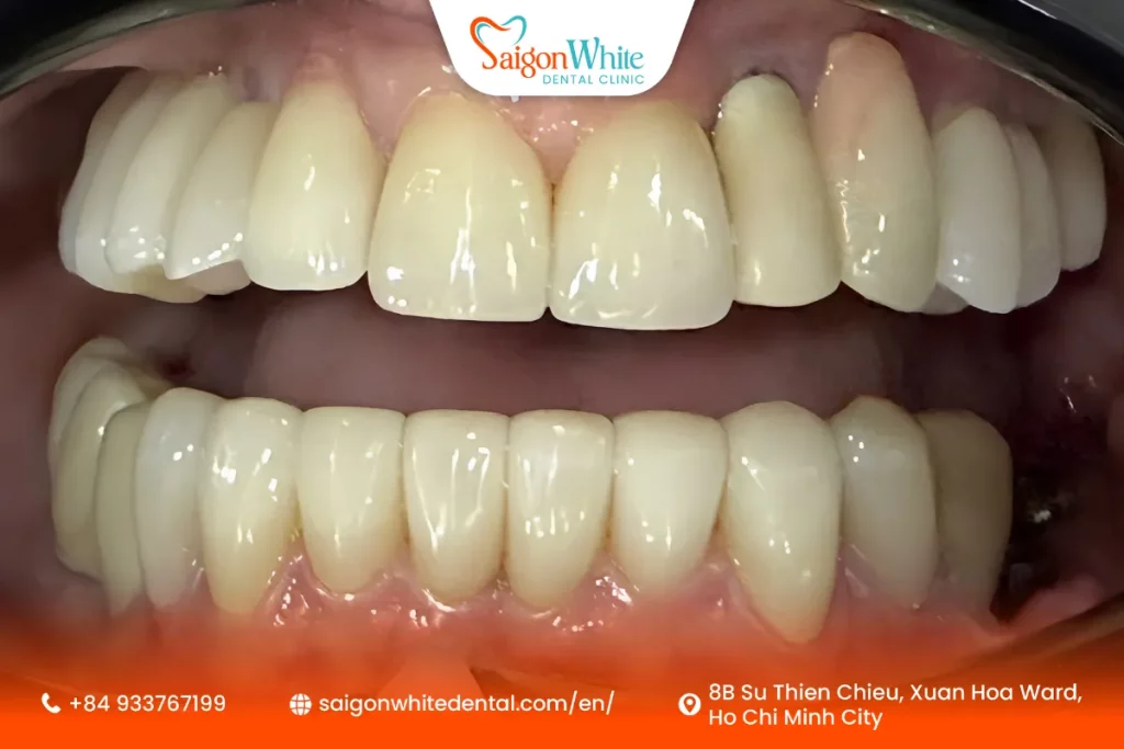 Comprehensive Full Smile Restoration for Mrs. Fischer