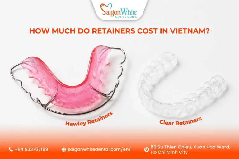 How Much Do Retainers Cost in Vietnam?