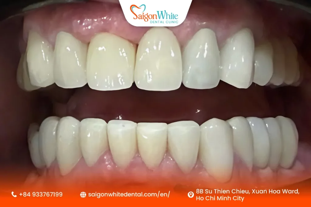 Mr. Haymo Fischer's Dental Condition After Treatment