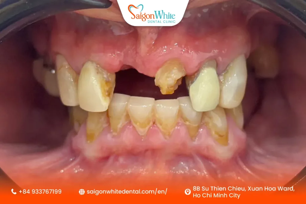 Mr. Haymo Fischer's Dental Condition Before Treatment
