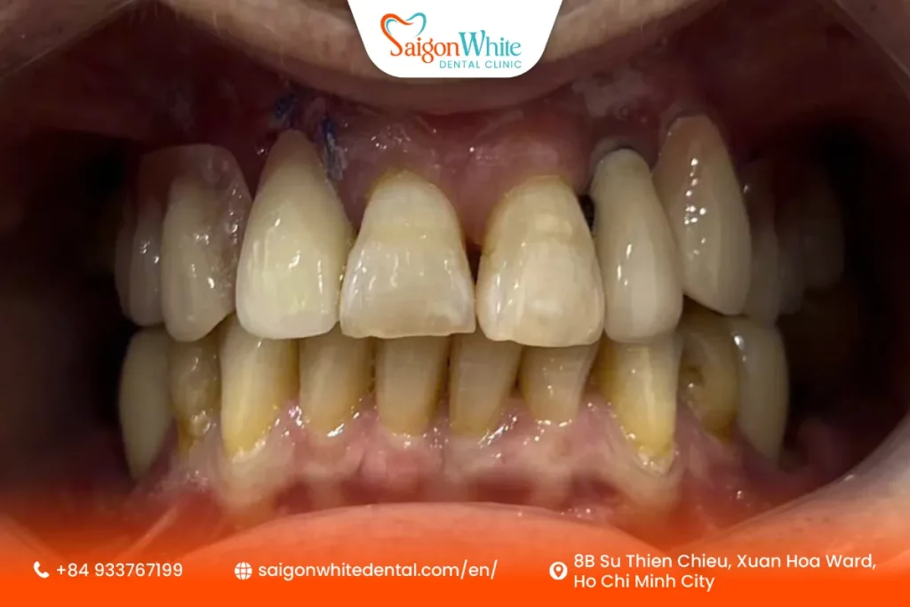 Mrs. Lynette Fischer's Dental Condition Before Treatment