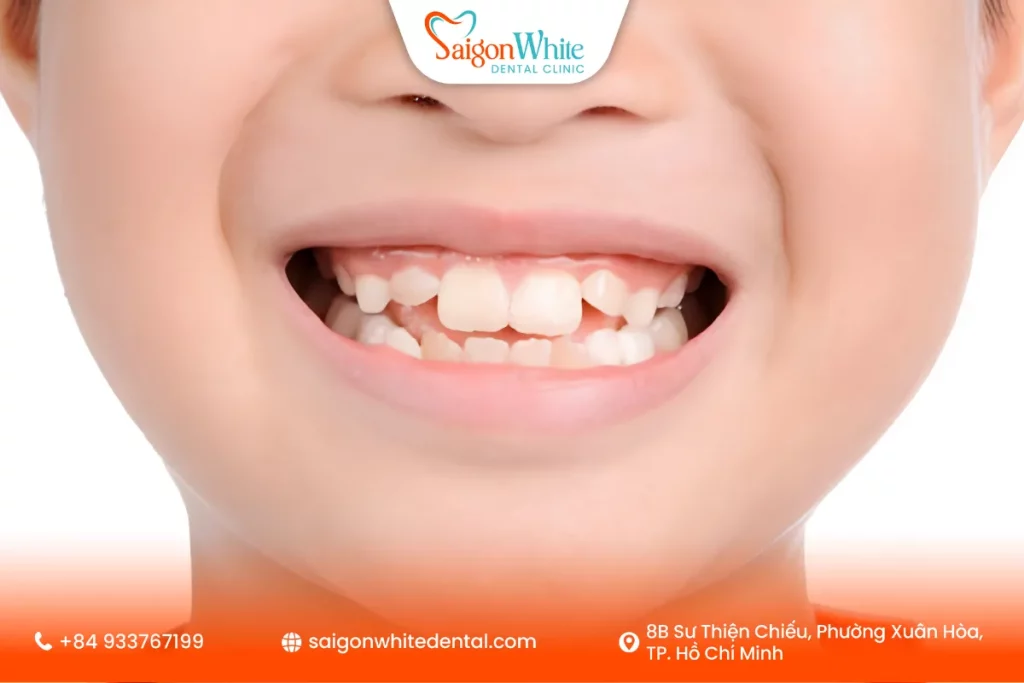Răng mọc sai vị trí từ sớm