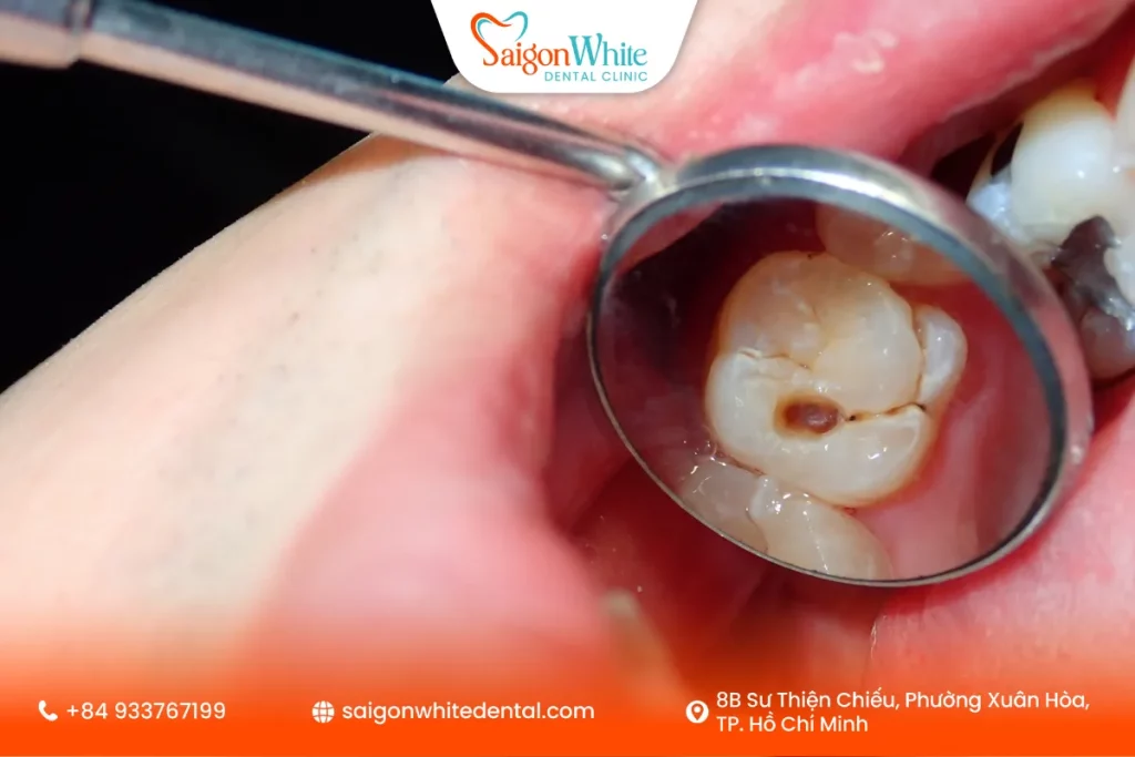 Sâu răng để lâu dẫn đến nhức răng