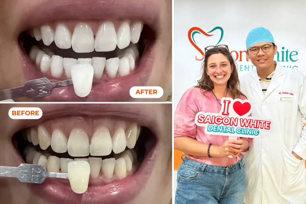 Before and after teeth whitening