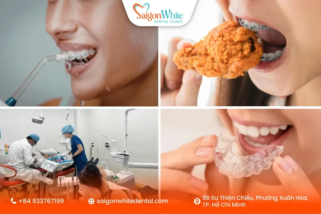 Cách chăm sóc khi niềng răng móm