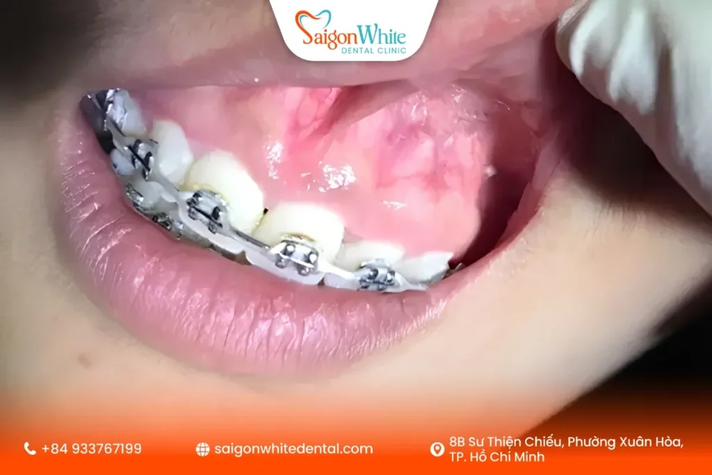 Dấu hiệu nhận biết tiêu xương khi niềng răng