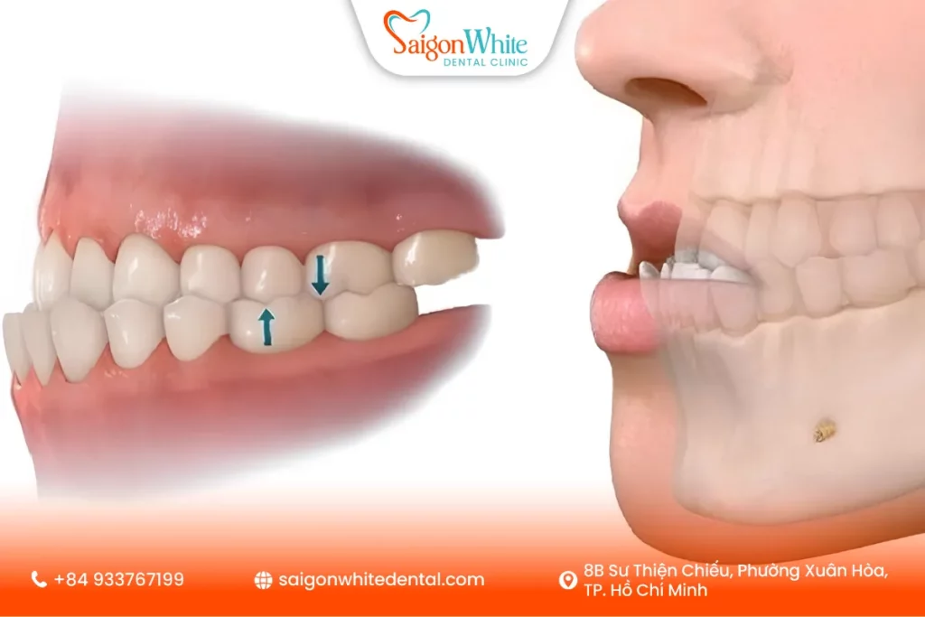 Dấu hiệu nhận biết tình trạng khi răng móm nhẹ