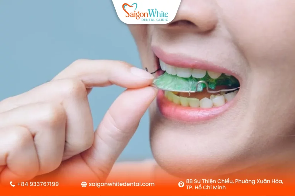 Điều gì xảy ra nếu không đeo hàm duy trì?