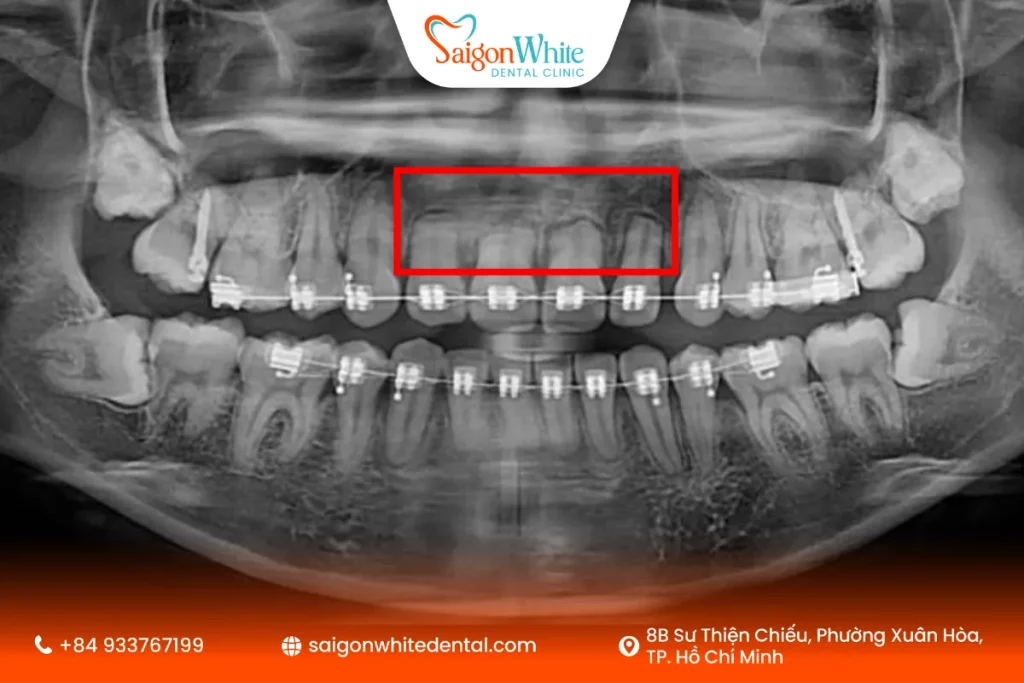 Niềng răng bị tiêu xương