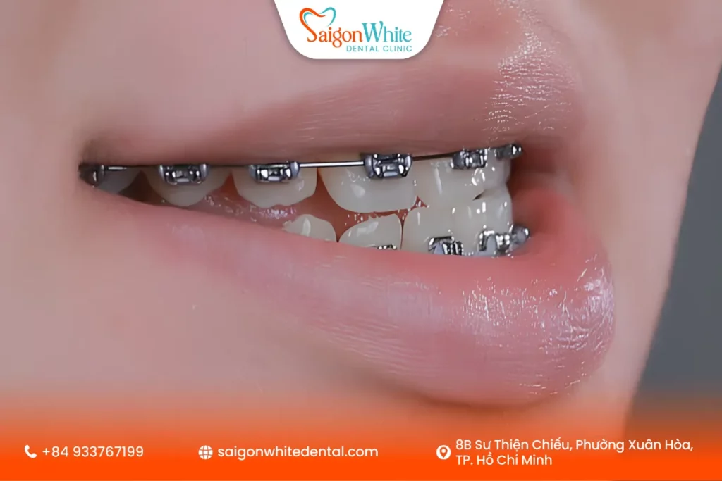 Niềng răng móm là gì?