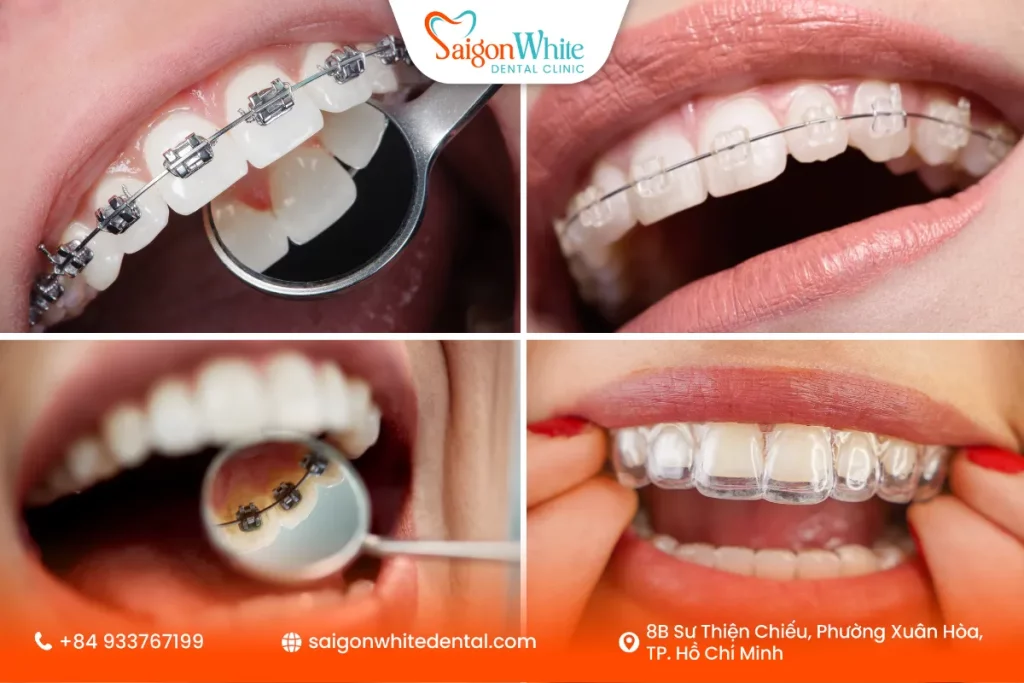 Các phương pháp niềng răng móm phổ biến hiện nay