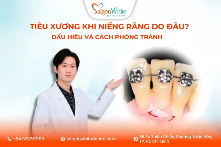 Tiêu xương khi niềng răng do đâu? Dấu hiệu và cách phòng tránh