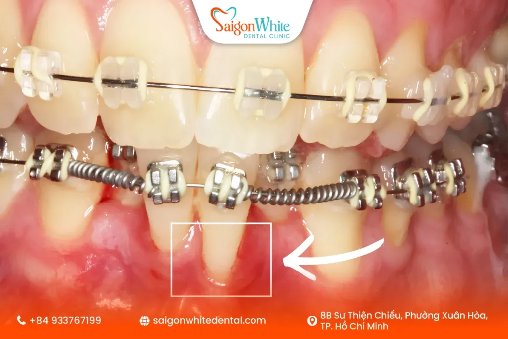 Vì sao niềng răng có thể gây tiêu xương?