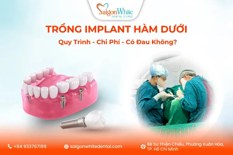 Trồng Implant Hàm Dưới
