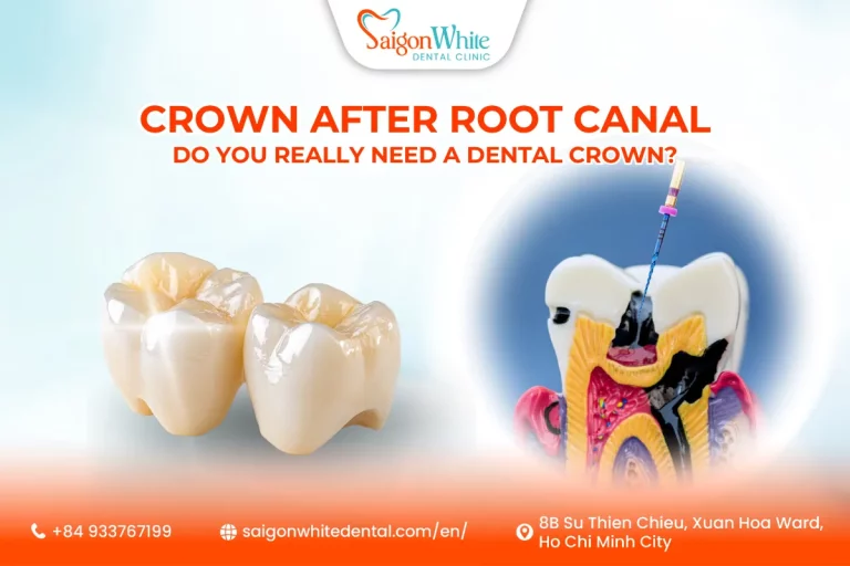 Crown After Root Canal Do You Really Need a Dental Crown