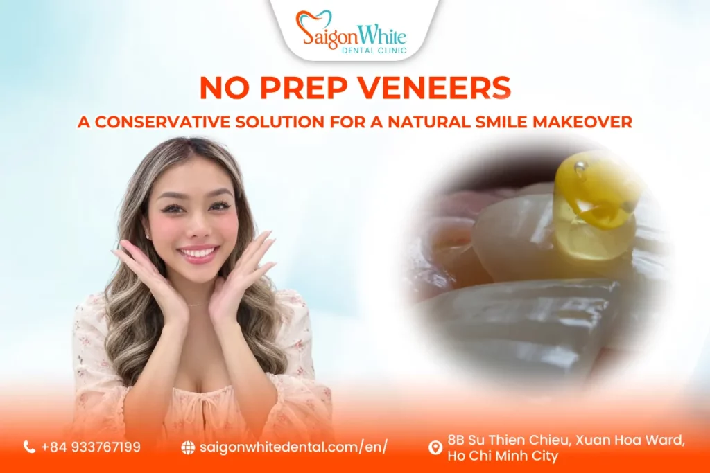 No Prep Veneers A Conservative Solution for a Natural Smile Makeover